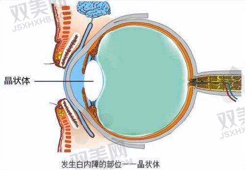 三、别让“白内障”免费了,但晶体偷偷升级收费