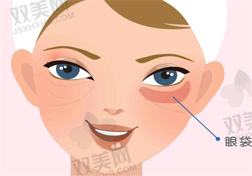 花11500在成都新丽美找游晓波做内路法下睑袋矫正术，无切口恢复快体验超棒