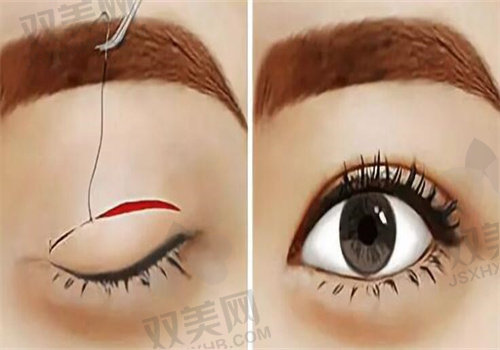 亲测！花18500找成都新丽美游晓波做眼睑闭合不全整復术，动态调整超棒！