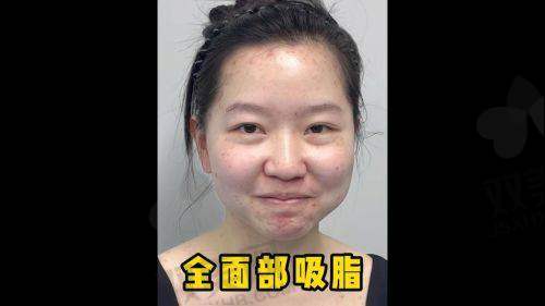 术前纠结与选择