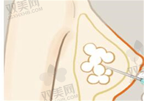 成都新丽美陈再洪医生做男性乳房肥大脂肪抽吸术9800元起,男性专研塑造自然胸形