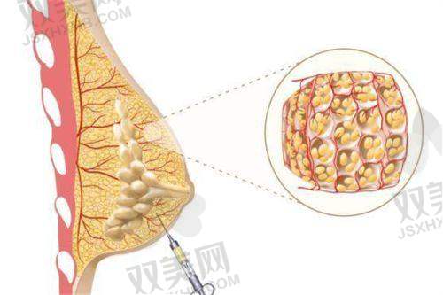 成都新丽美陈再洪医生做男性乳房肥大脂肪抽吸术预约挂号方式