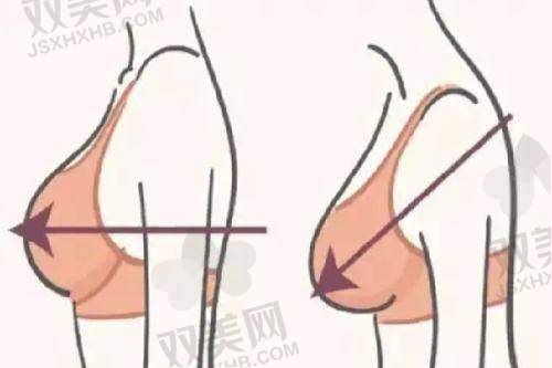 成都新丽美陈再洪医生做男性乳房肥大脂肪抽吸术价格详情