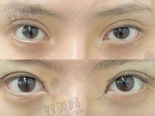 重庆美仑美奂董开云做东方原生美眼凝血技术版技术优势