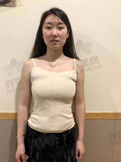 成都新丽美陈再洪医生做男性乳房肥大脂肪抽吸术技术优势