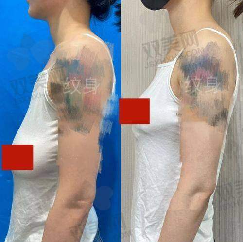 成都新丽美陈再洪医生做男性乳房肥大脂肪抽吸术用户口碑