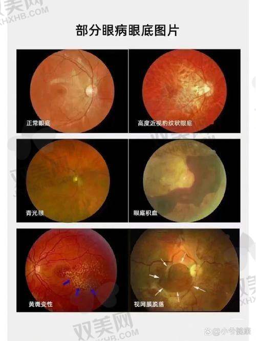 【呼和浩特市回民医院眼科怎么样】