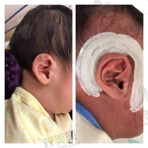 成都新丽美陈再洪医生做耳轮脚成形术预约挂号的方式