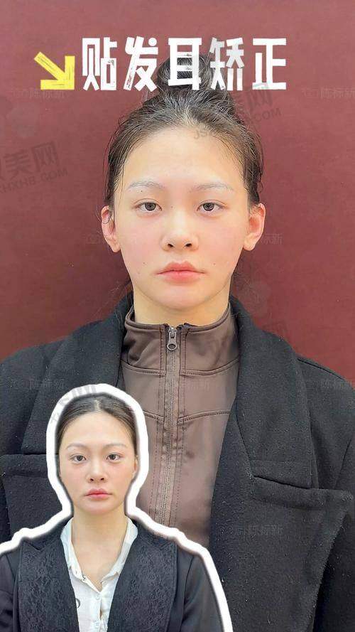 耳轮脚成形术的成功实例