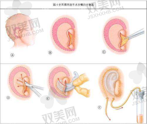成都新丽美陈再洪医生做耳轮脚成形术的价格