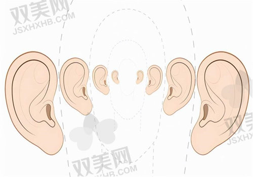 成都新丽美陈再洪医生做耳屏畸形矫正术(先天性缺如)【12800元起】,重建耳屏兼顾面部整体协调