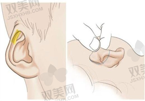 成都新丽美陈再洪医生做耳廓再造翻修术(外院)35800元起,高难度翻修重塑形态功能