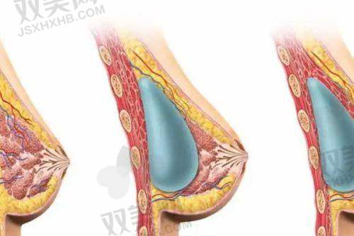 黄岩隆胸傲诺拉的价格构成