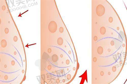 黄岩隆胸傲诺拉的安心性问题