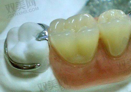 金属托槽矫正的注意事项