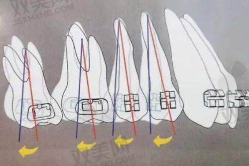 片切后如何护理牙齿？