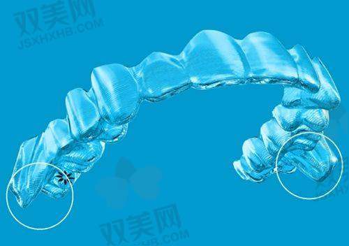 金属托槽矫正的注意事项