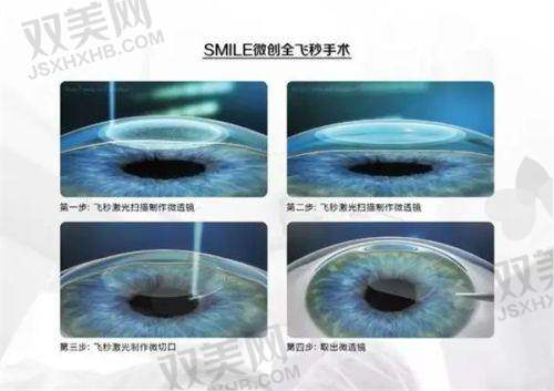 如何选择性价比高的近视手术