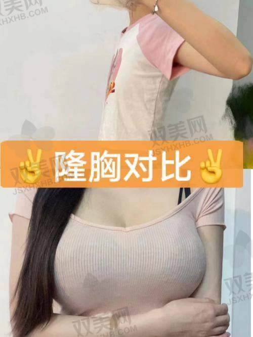 傲诺拉隆胸后的修复过程