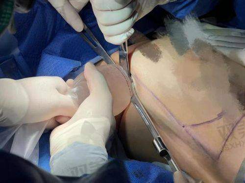 黄岩隆胸傲诺拉的变软时间解析