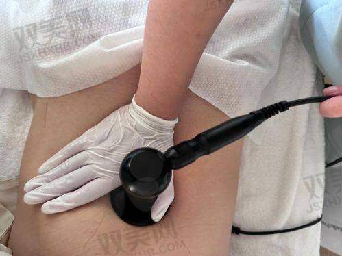 成都新丽美陈再洪医生做小腿脂肪抽吸术技术优势