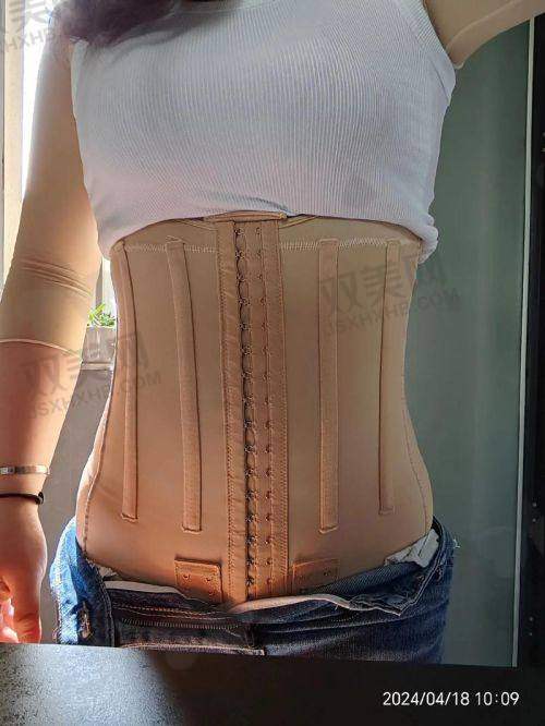 成都新丽美陈再洪医生做小腿脂肪抽吸术成功实例