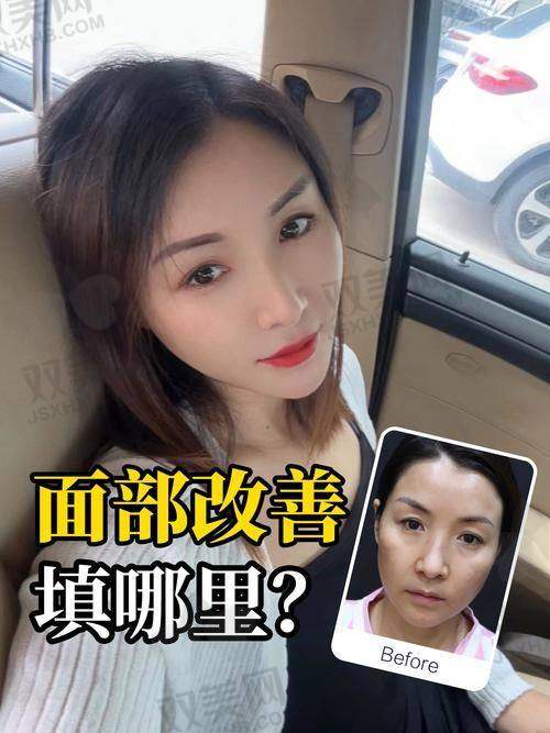 鼻唇沟脂肪移植术技术优势