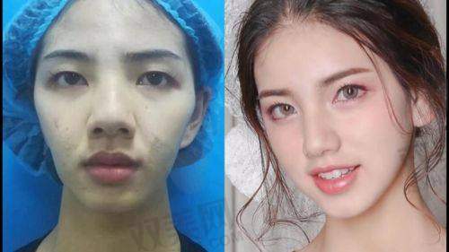 陈再洪医生鼻唇沟脂肪移植术实例