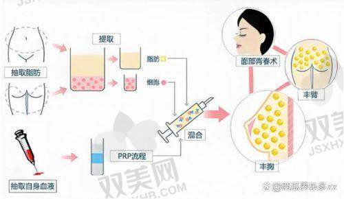 成都新丽美陈再洪医生做鼻唇沟脂肪移植术预约挂号方式