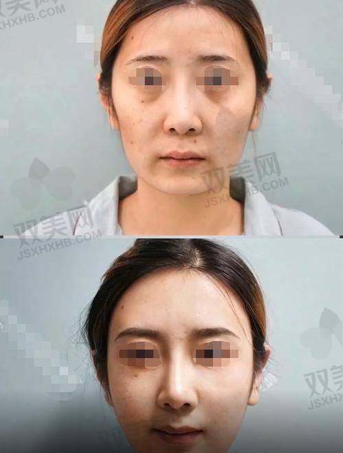 成都新丽美陈再洪医生鼻唇沟脂肪移植术价格