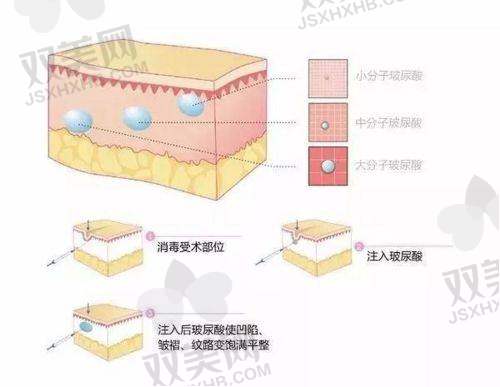 结语:Fill少女针虽贵,但贵得有理,买的就是“效期 + 自然”!