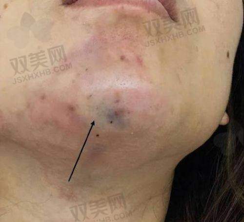 二、ellanse少女针填充法令纹成效到底咋样?真实实例告诉你!