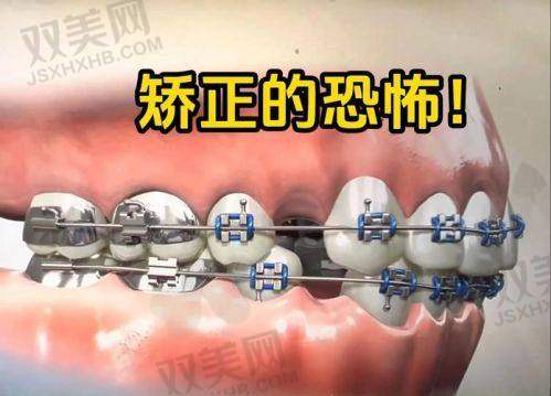 片切与拔牙矫正如何选择？