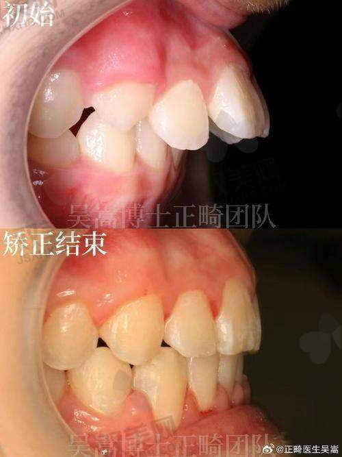 什么是正畸摇椅弓