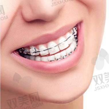 自锁托槽矫正成效