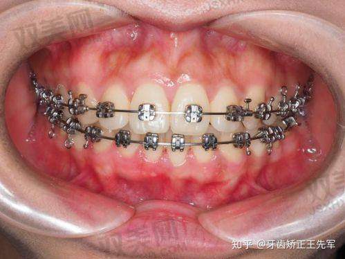 揭秘金属托槽矫治器价格