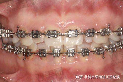 自锁托槽与金属托槽矫治器差异