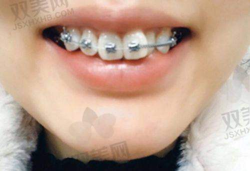金属托槽矫正的优缺点分析
