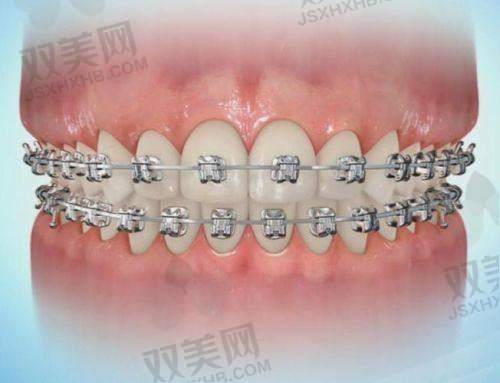 不同金属托槽成效对比