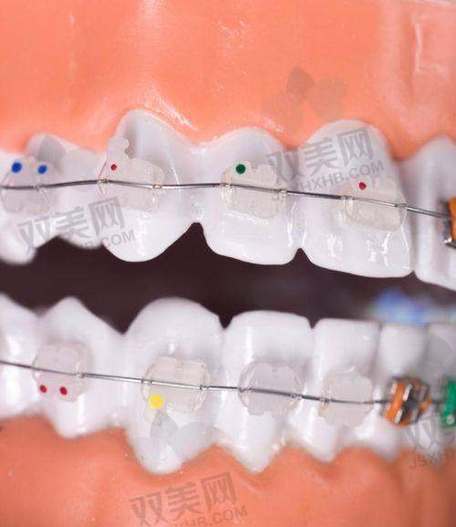 金属托槽价格大揭秘