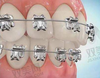 隐形牙套与金属托槽矫治器差异