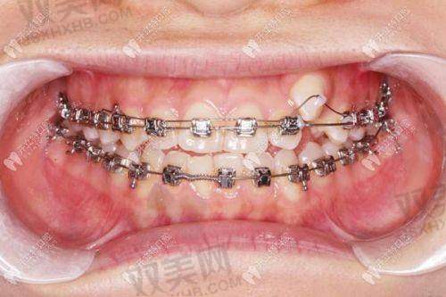 自锁托槽矫正原理