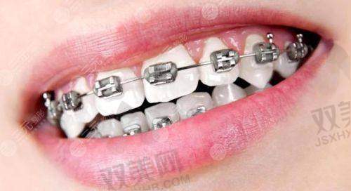金属托槽矫正成效