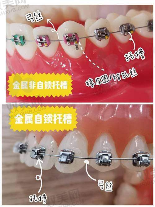 金属托槽矫正原理