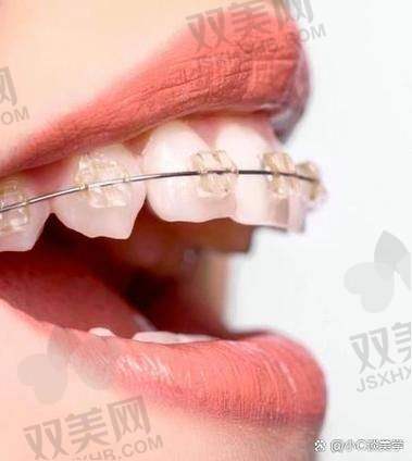 如何选择适合自己的矫正方式