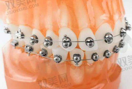 金属托槽矫正后的护理要点