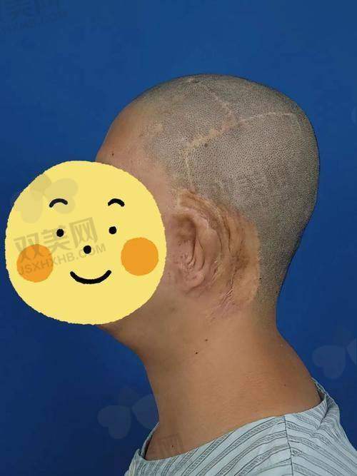 五、成都新丽美陈再洪医生做耳屏畸形矫正术(先天性缺如)的口碑