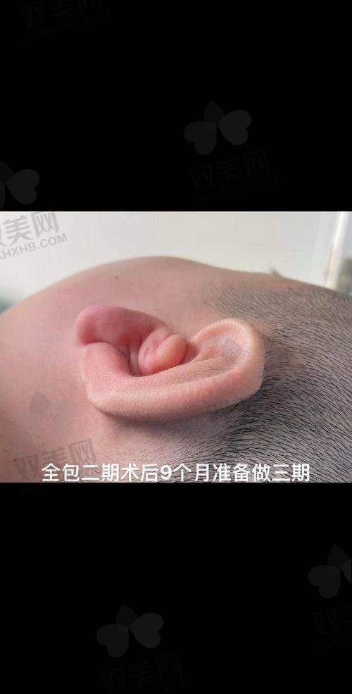 一、成都新丽美陈再洪医生做耳廓再造翻修术(外院)价格