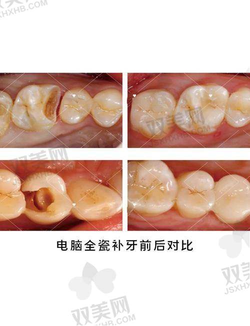 总结:怎么选?一图给你补牙方案配对锦囊!