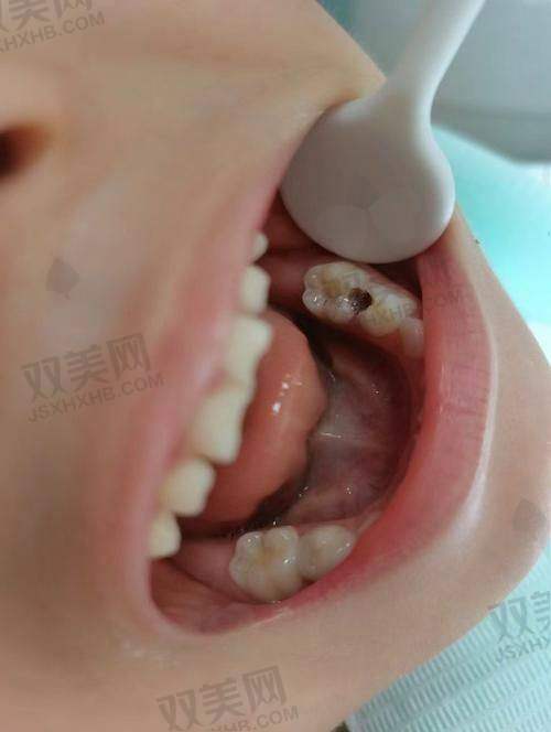 3M Z250和Z350都是树脂?它们材质到底差哪儿了?